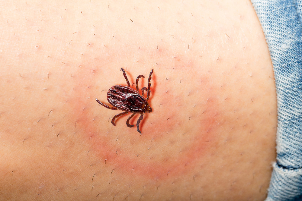 tick lyme disease